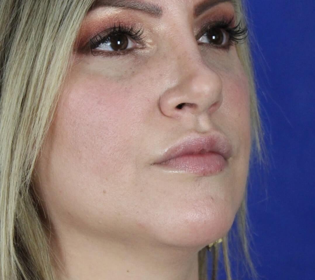 Case--6897 | Before Face 4