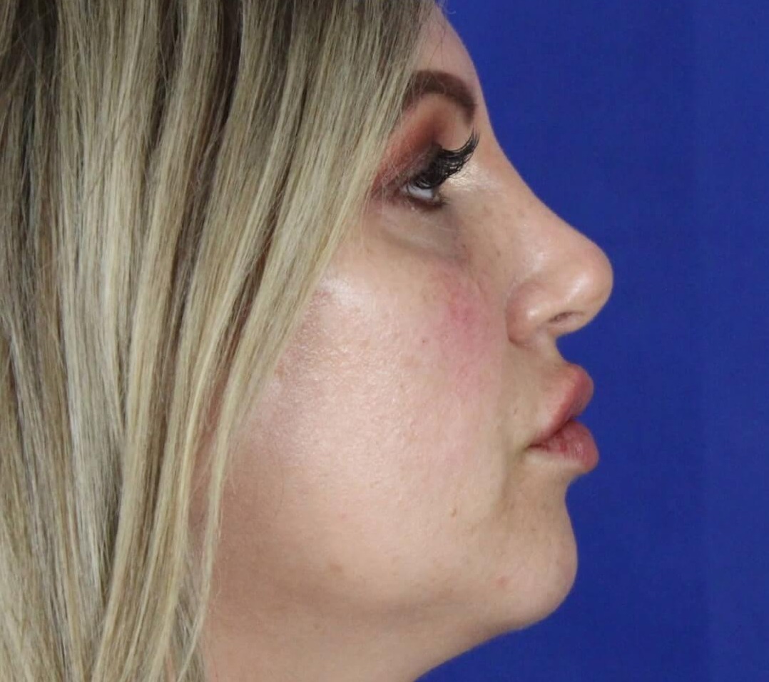 Case--6897 | After Face 5