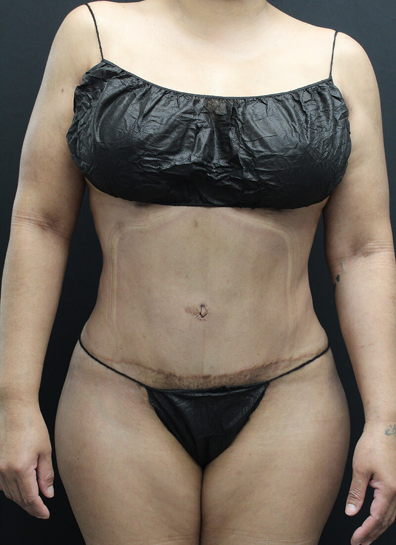 Case--1900 | After Liposuction 1