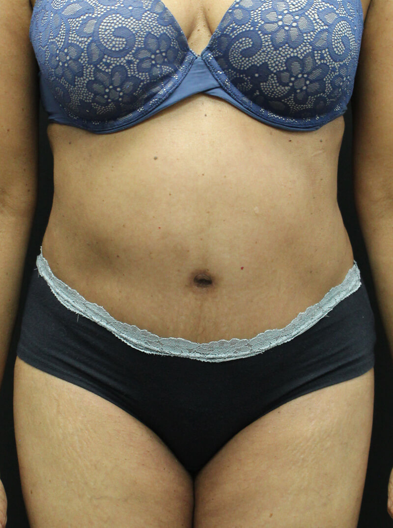Case--6954 | After Abdominoplasty 1