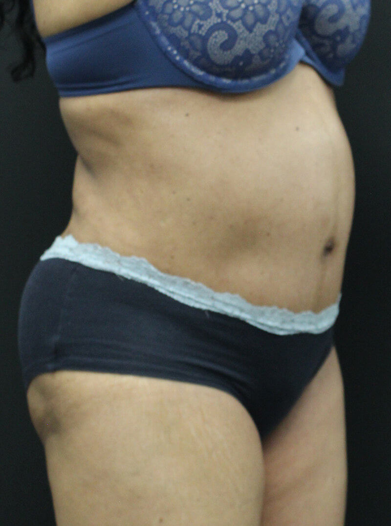 Case--6954 | After Abdominoplasty 2