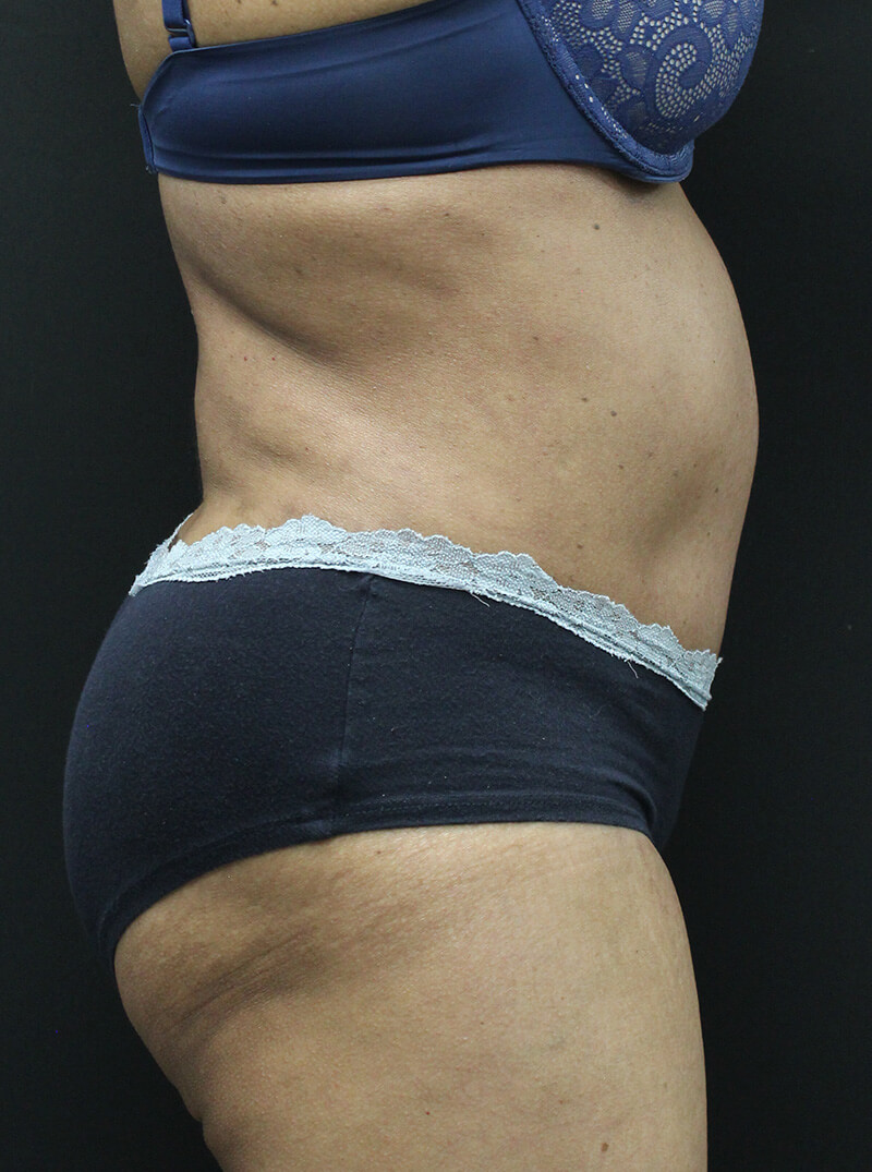 Case--6954 | After Abdominoplasty 3