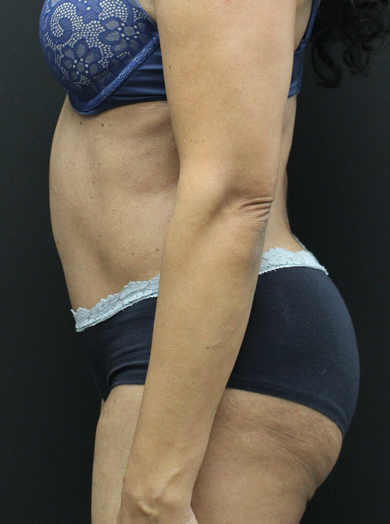 Case--6954 | After Abdominoplasty 5