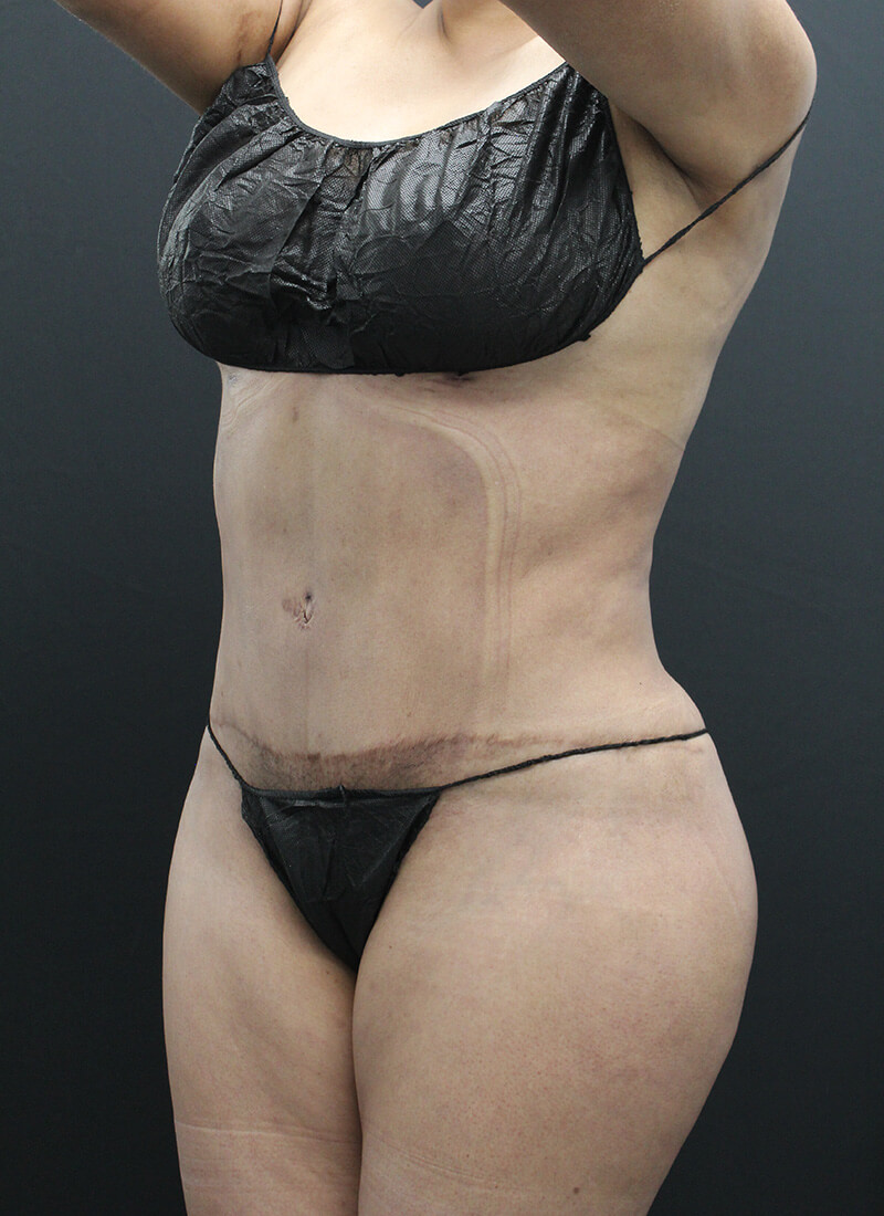 Case--1900 | After Liposuction 6