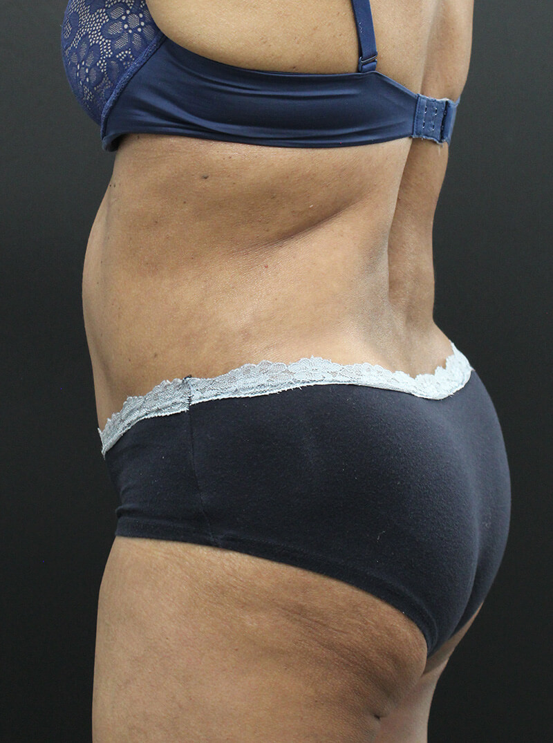 Case--6954 | After Abdominoplasty 8