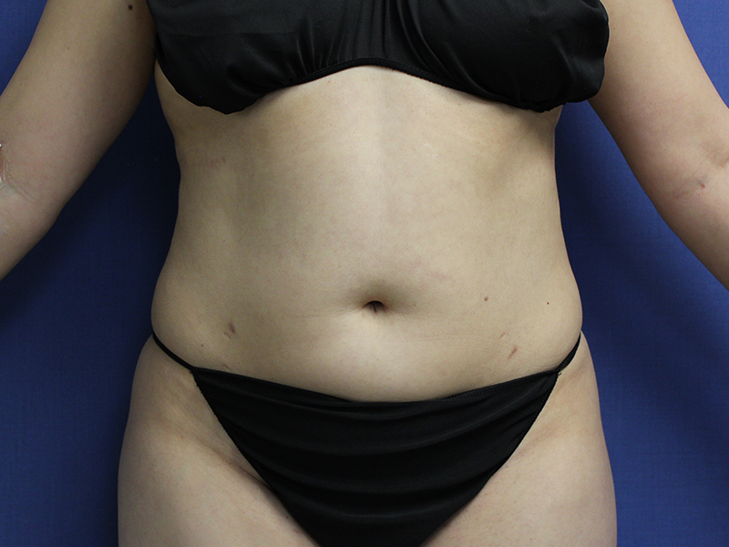 Case--5780 | Before Awake Liposuction 1