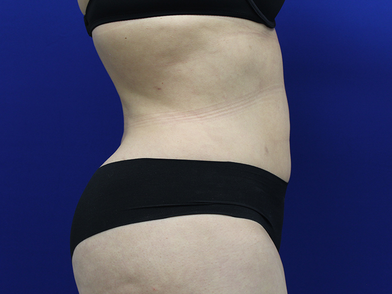 Case--5780 | After Awake Liposuction 2