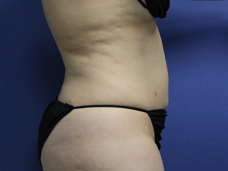 Case--5780 | Before Awake Liposuction 2