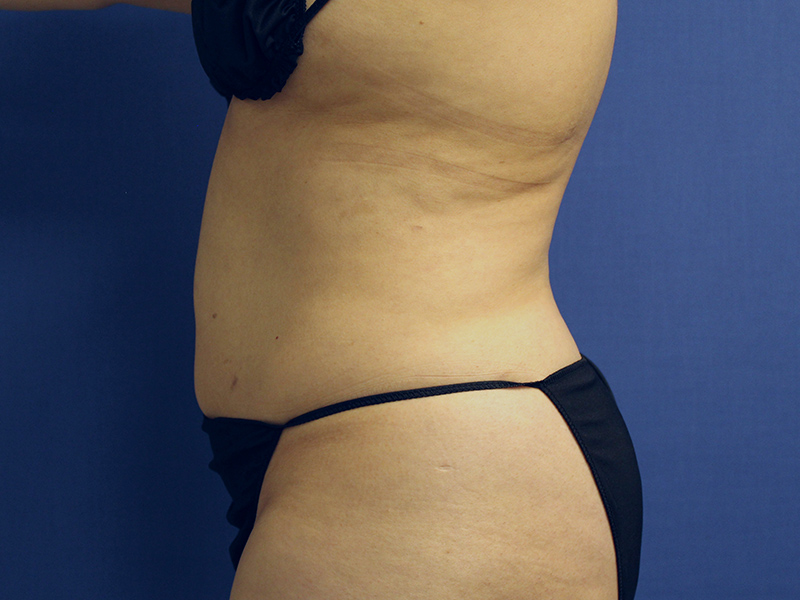 Case--5780 | Before Awake Liposuction 3