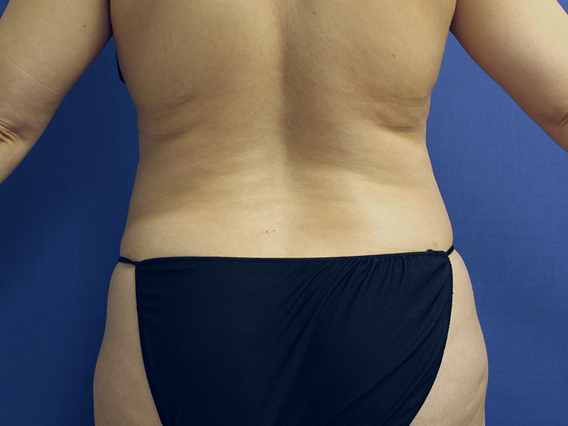 Case--5780 | Before Awake Liposuction 4