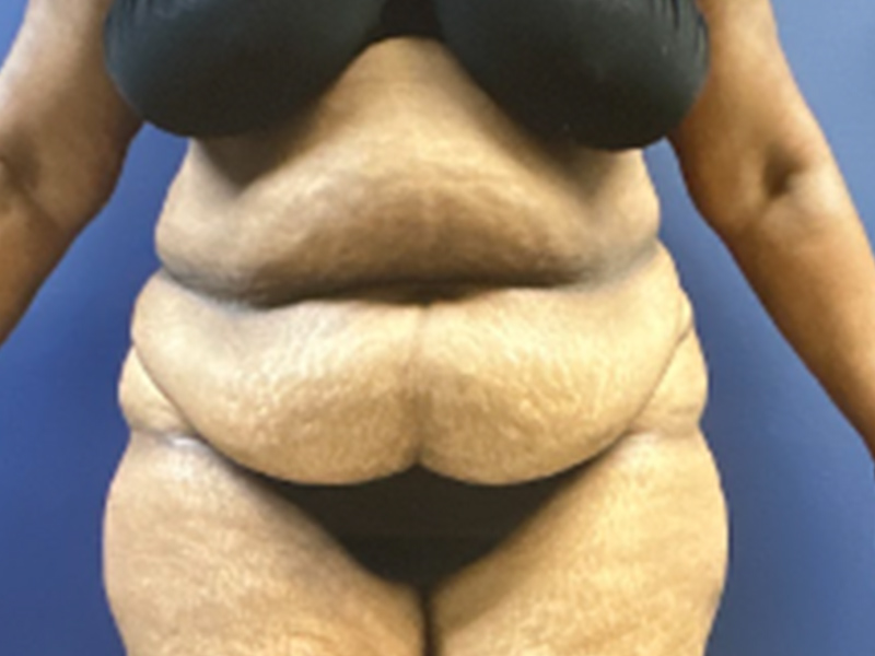 Case--7873 | Before Abdominoplasty 1