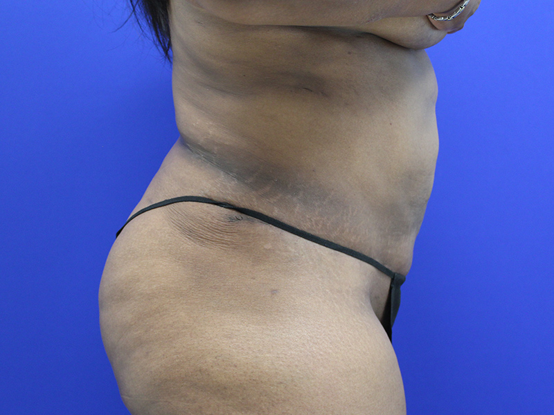 Case--7873 | After Abdominoplasty 2
