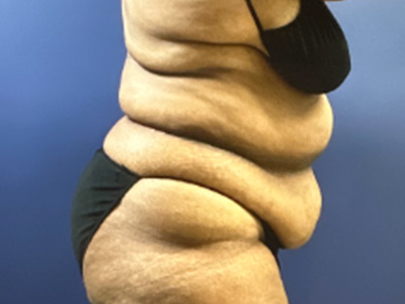 Case--7873 | Before Abdominoplasty 2