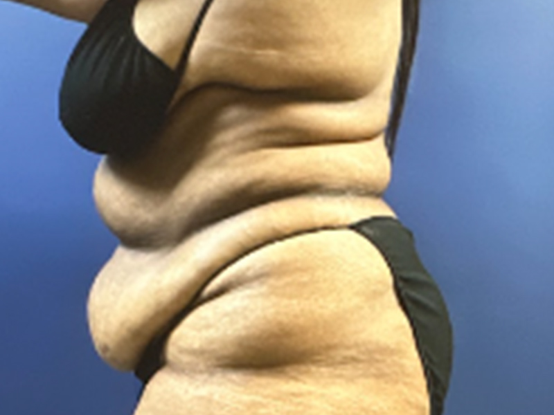 Case--7873 | Before Abdominoplasty 3