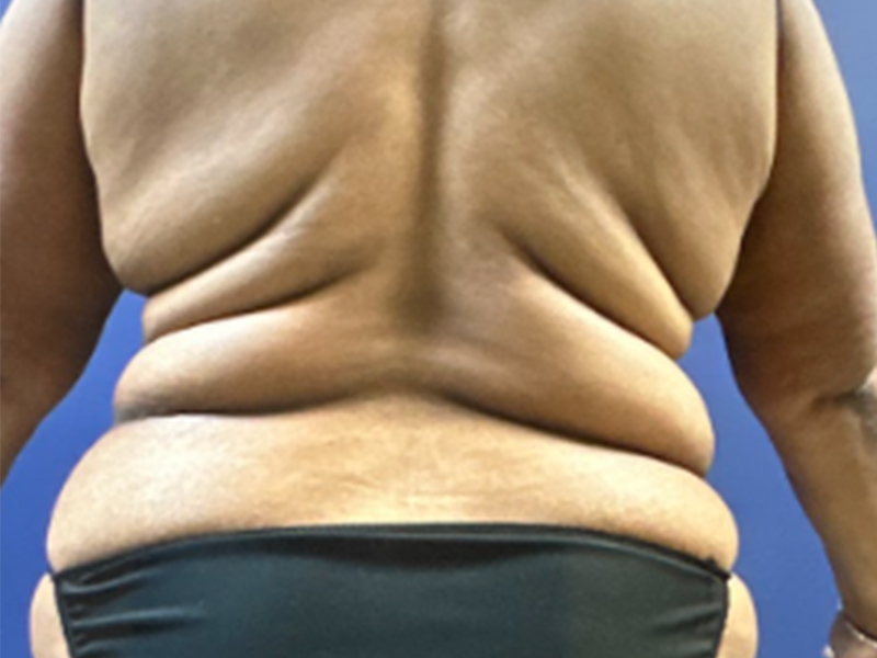 Case--7873 | Before Abdominoplasty 4