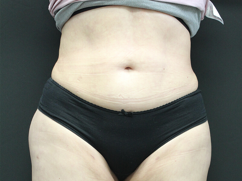 Case--5828 | After Awake Liposuction 1