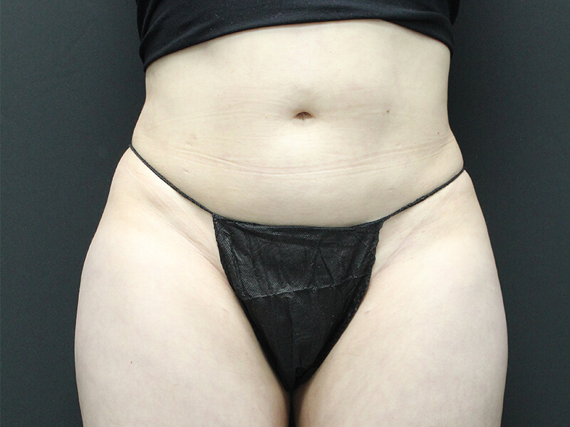 Case--5828 | Before Awake Liposuction 1
