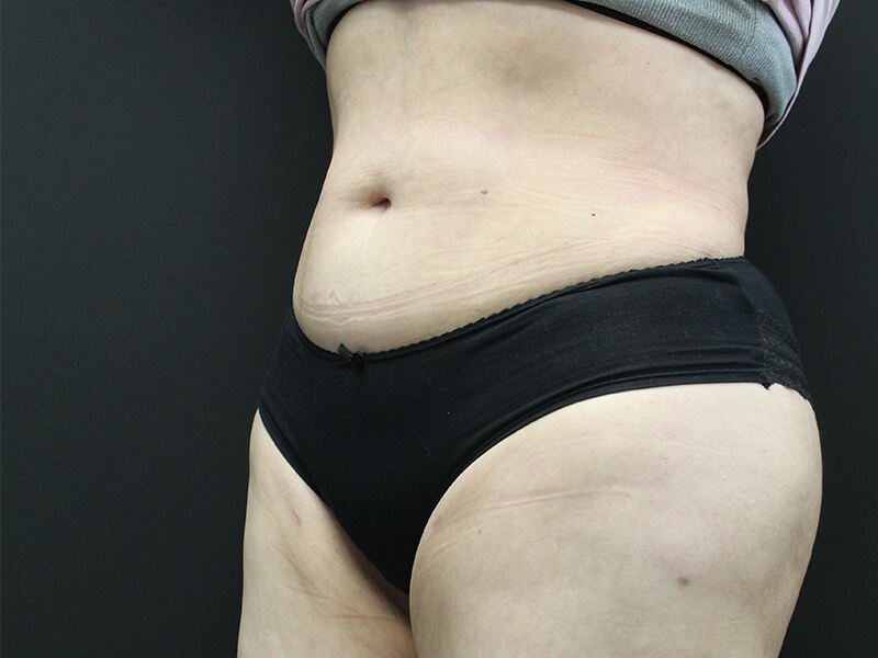 Case--5828 | After Awake Liposuction 2