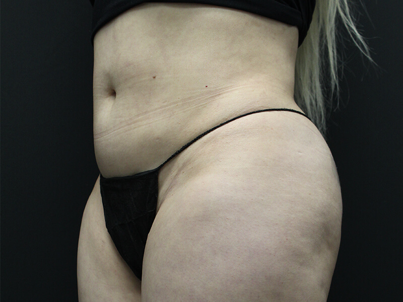 Case--5828 | Before Awake Liposuction 2
