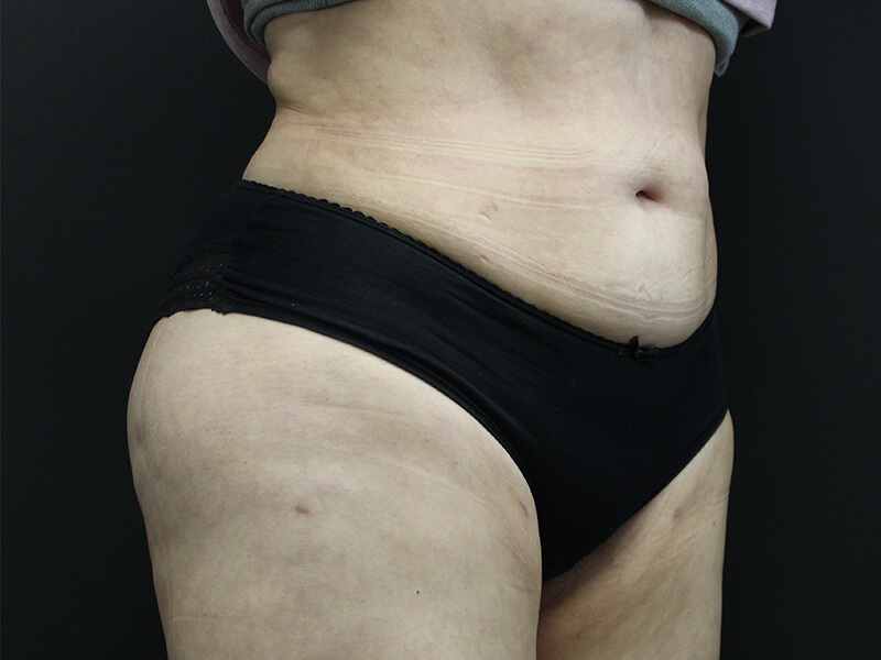Case--5828 | After Awake Liposuction 3