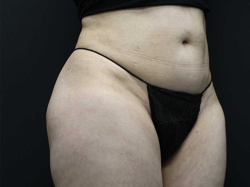 Case--5828 | Before Awake Liposuction 3