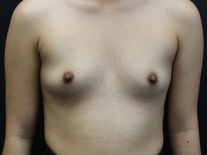 Case--6777 | Before Breast Augmentation 1
