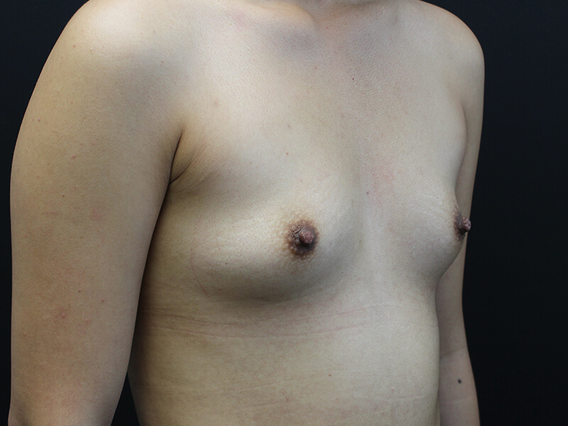 Case--6777 | Before Breast Augmentation 2