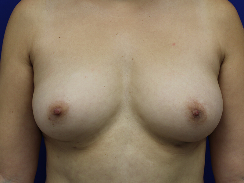 Case--6321 | Before Breast Augmentation 1