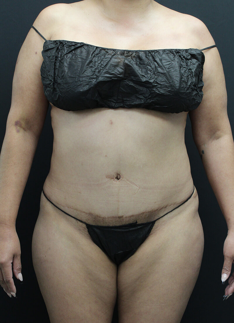 Case--1900 | Before Liposuction 1