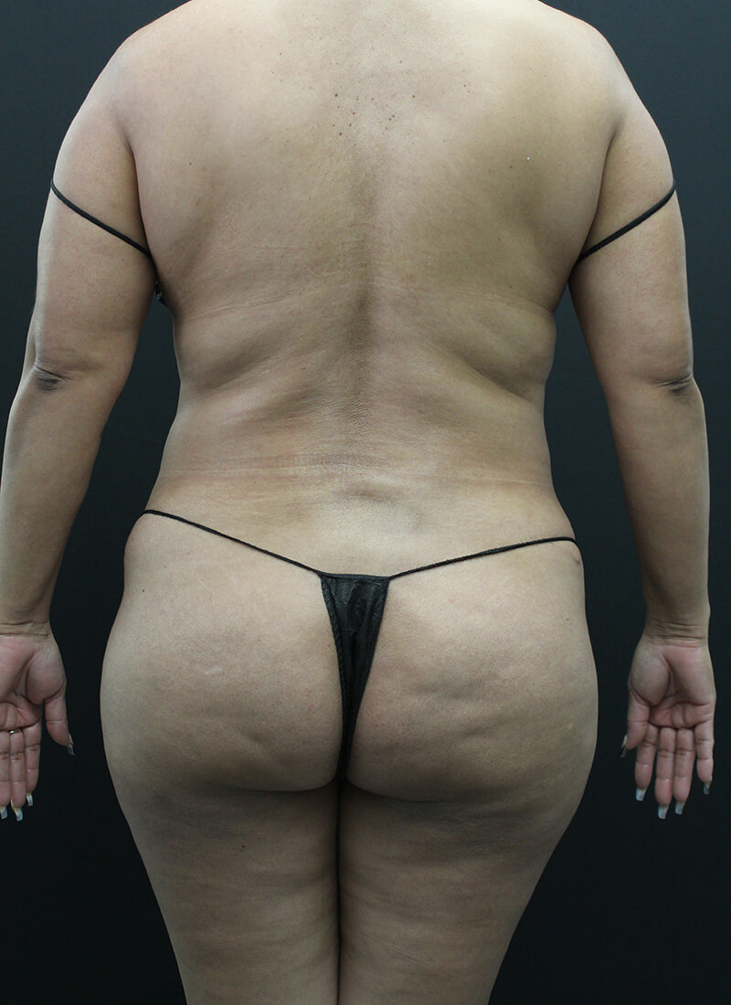 Case--1900 | Before Liposuction 10