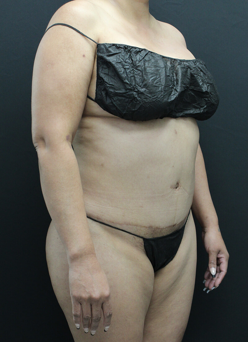 Case--1900 | Before Liposuction 2