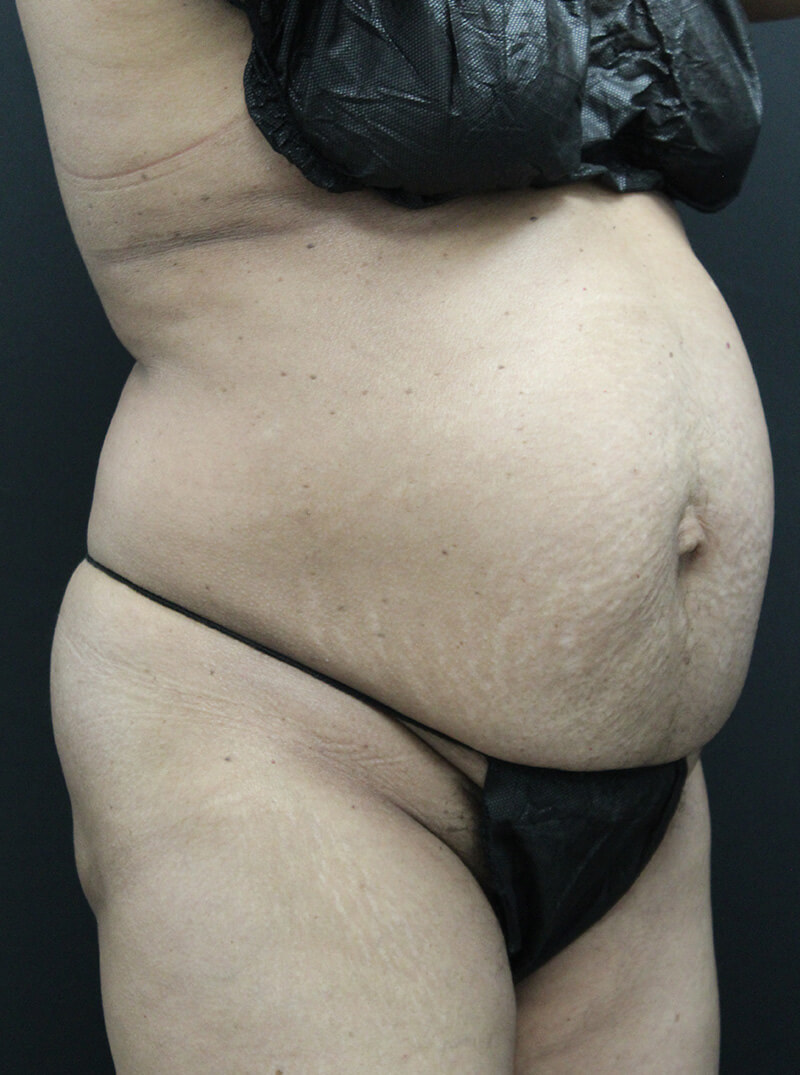 Case--6954 | Before Abdominoplasty 2