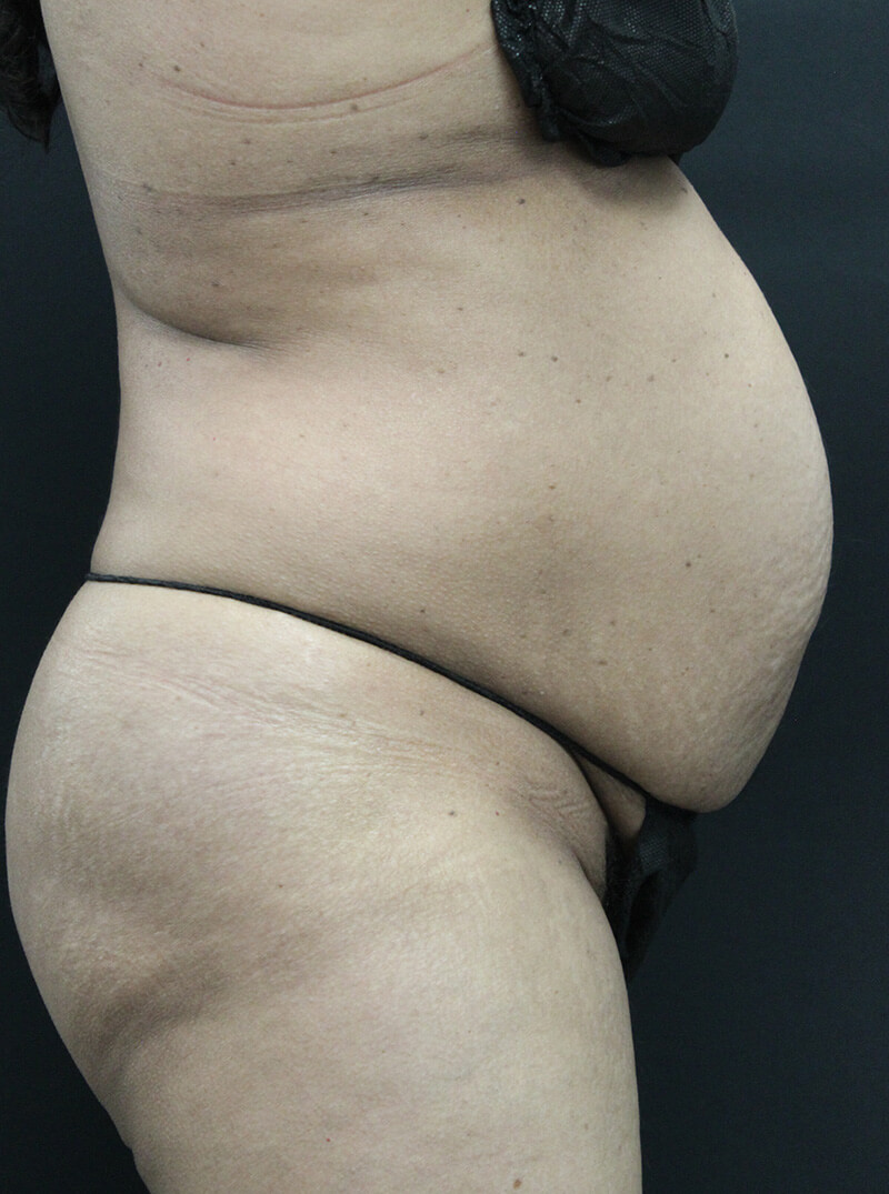 Case--6954 | Before Abdominoplasty 3