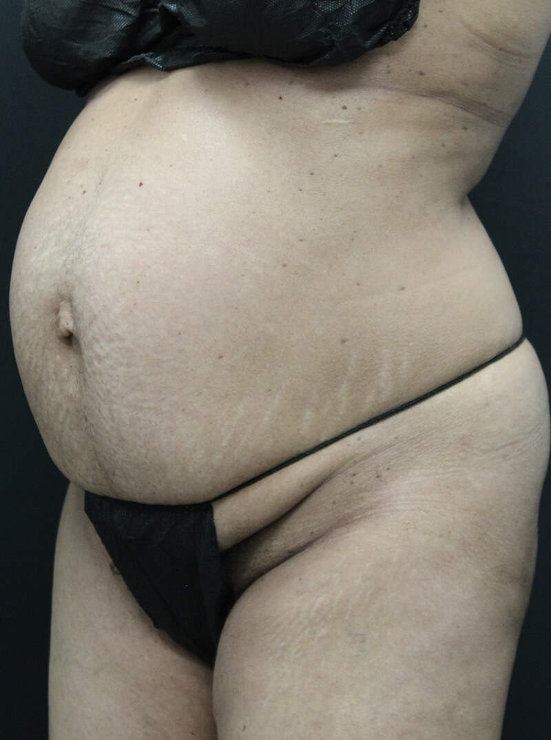 Case--6954 | Before Abdominoplasty 4