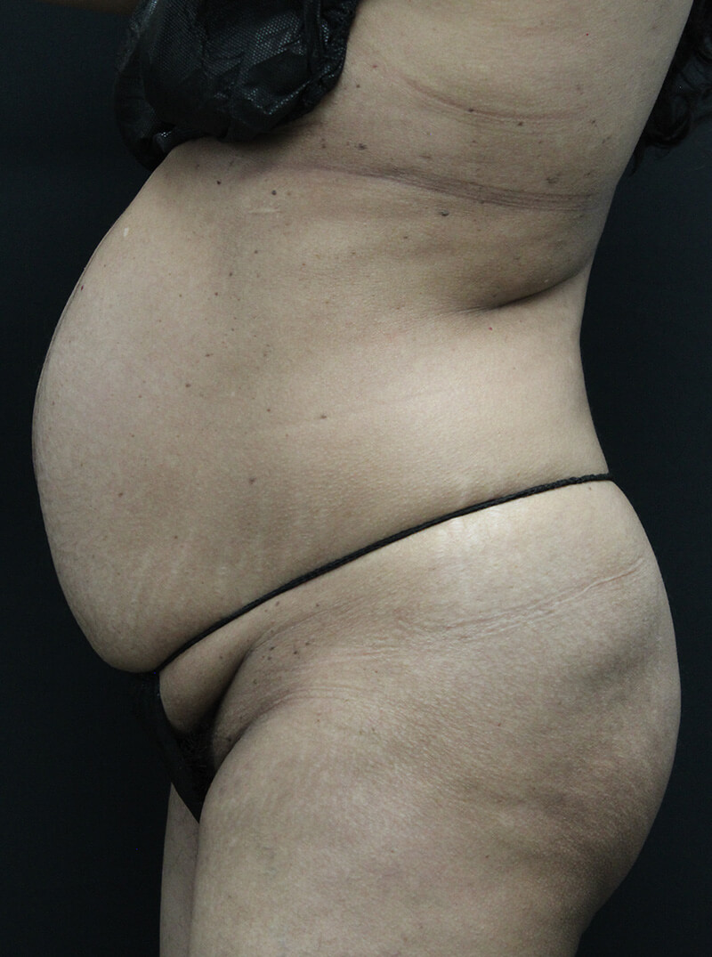 Case--6954 | Before Abdominoplasty 5