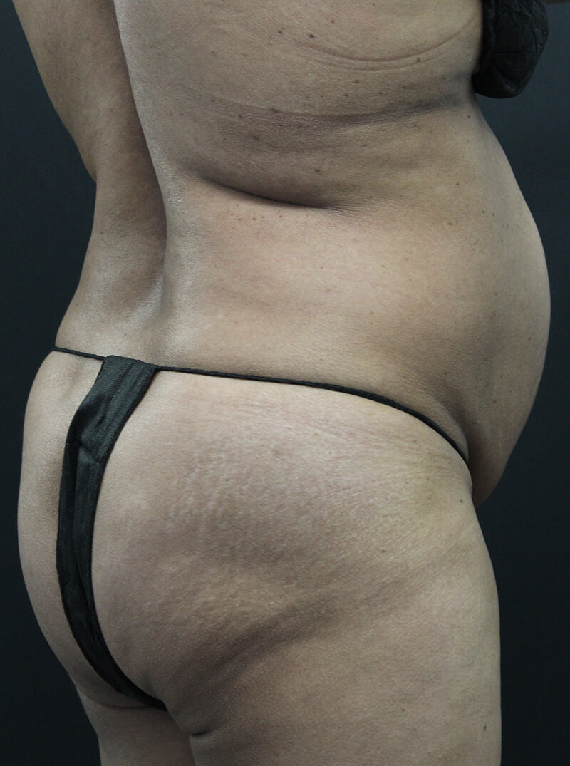 Case--6954 | Before Abdominoplasty 6