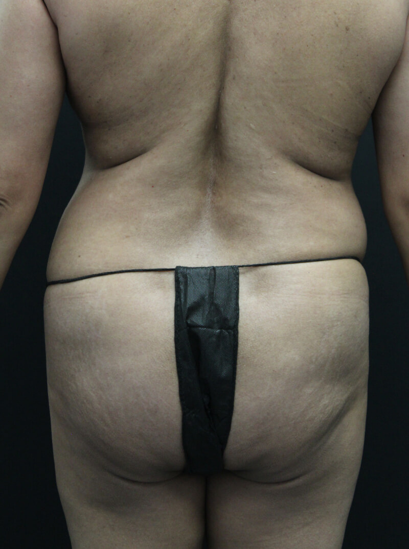 Case--6954 | Before Abdominoplasty 7