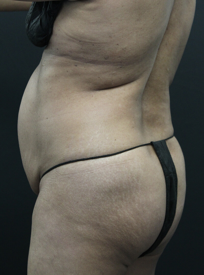 Case--6954 | Before Abdominoplasty 8