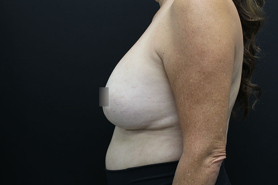 Case--4688 | After Breast Implant Exchange w-Lift 5