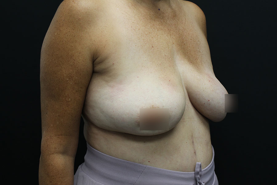 Case--4688 | Before Breast Implant Exchange w-Lift 2