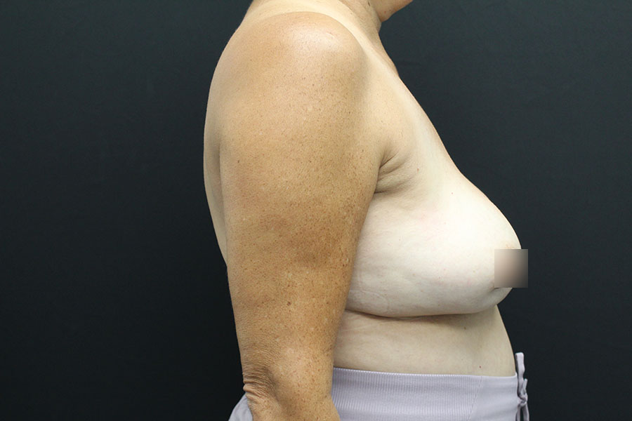 Case--4688 | Before Breast Implant Exchange w-Lift 4