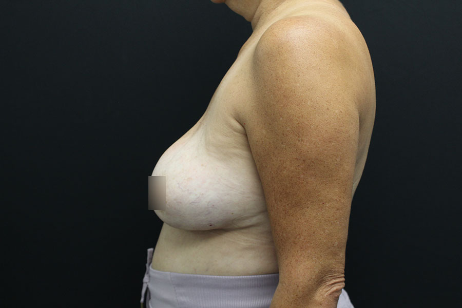 Case--4688 | Before Breast Implant Exchange w-Lift 5