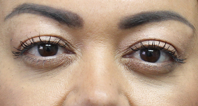 Case--4723 | After Face 1