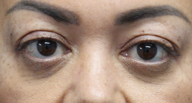 Case--4723 | Before Face 1