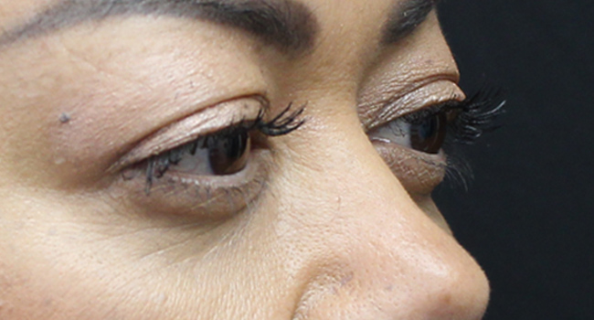 Case--4723 | After Face 2