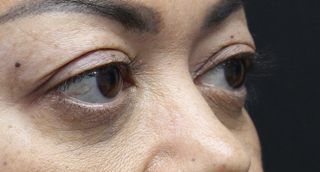 Case--4723 | Before Face 2