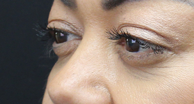 Case--4723 | After Face 3