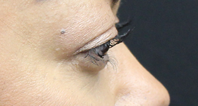 Case--4723 | After Face 4