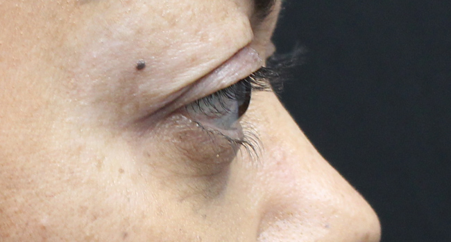 Case--4723 | Before Face 4