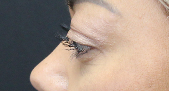 Case--4723 | After Face 5